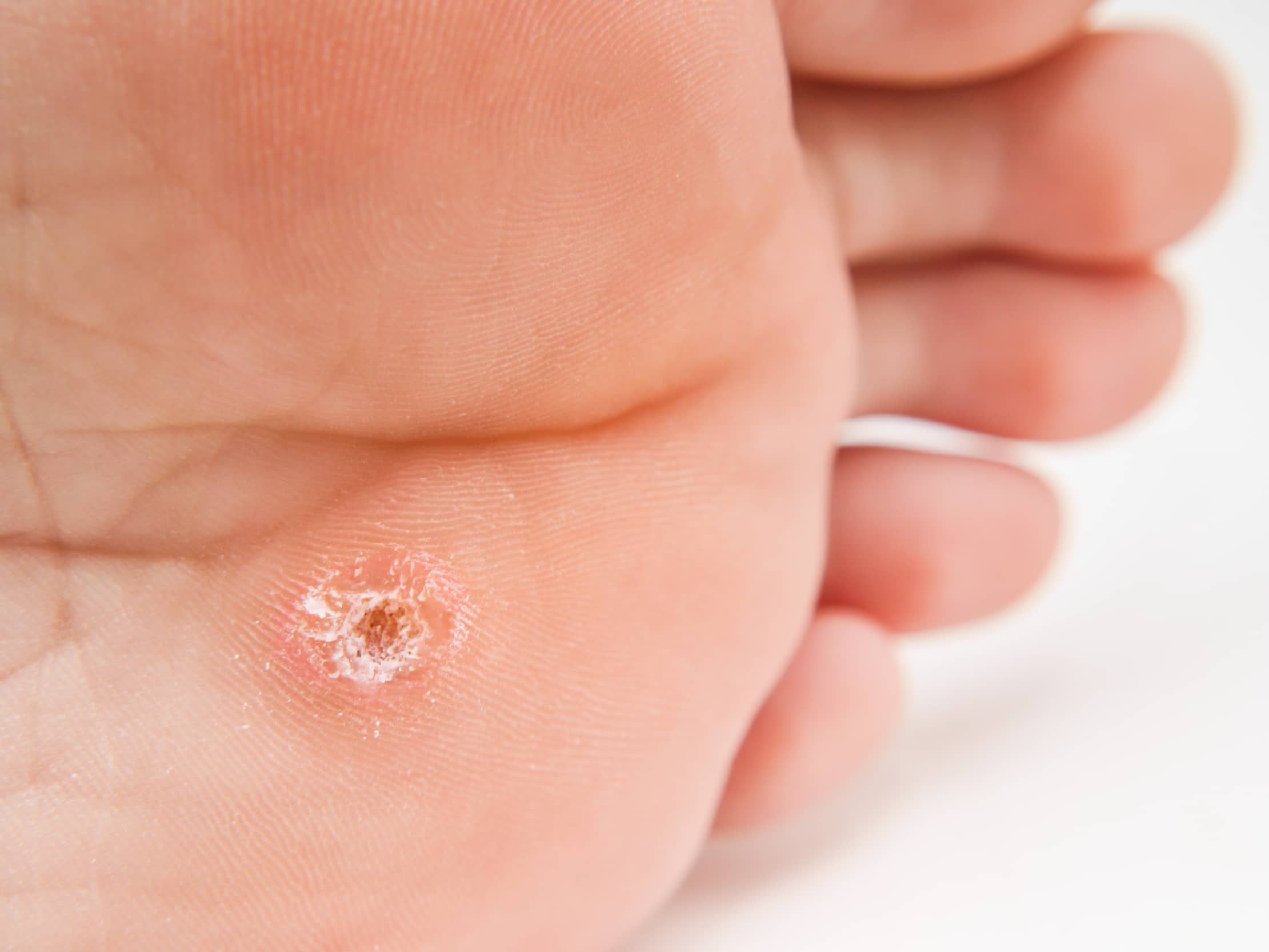 Warts; Molluscum contagiosum