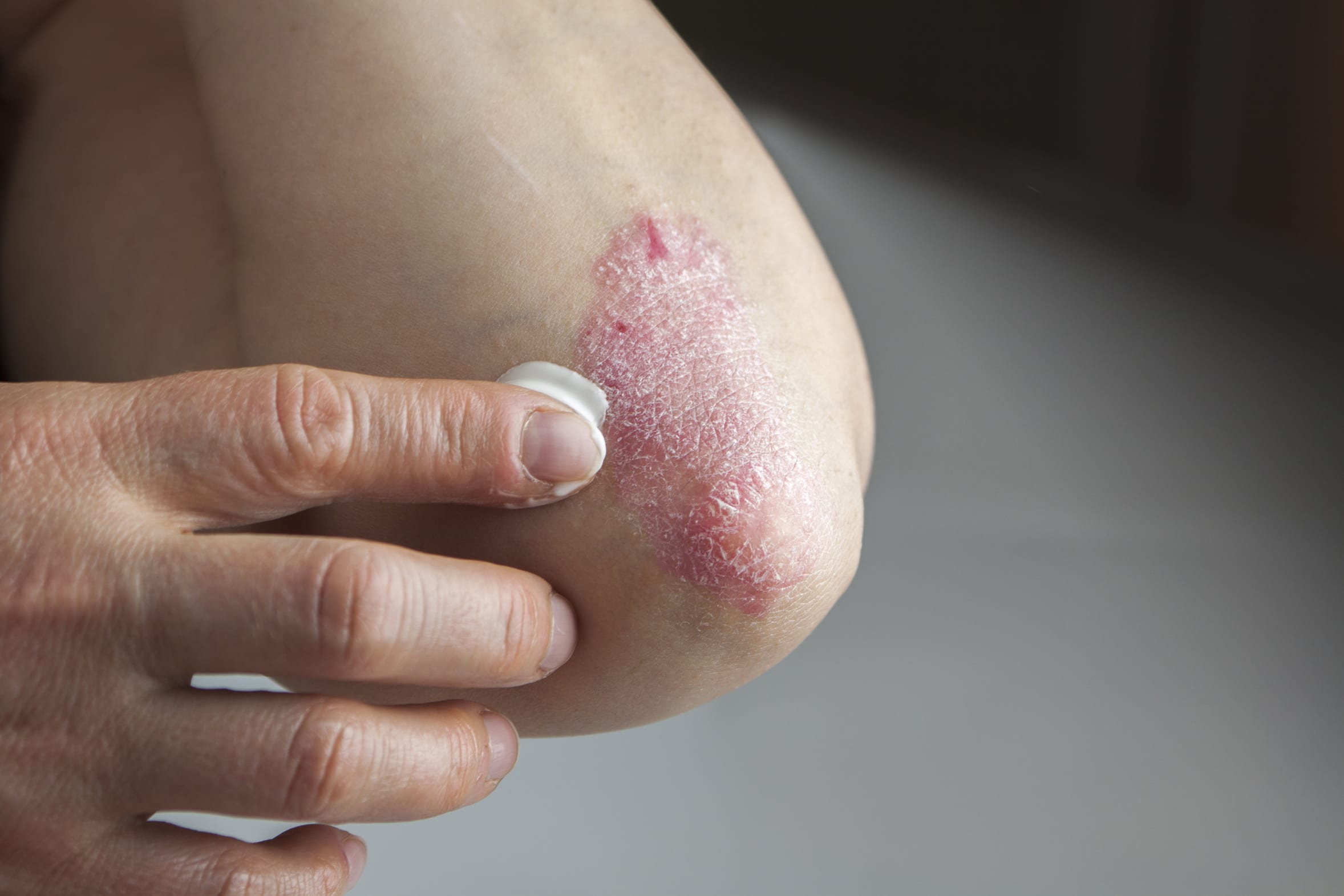 Schuppenflechte,Psoriasis