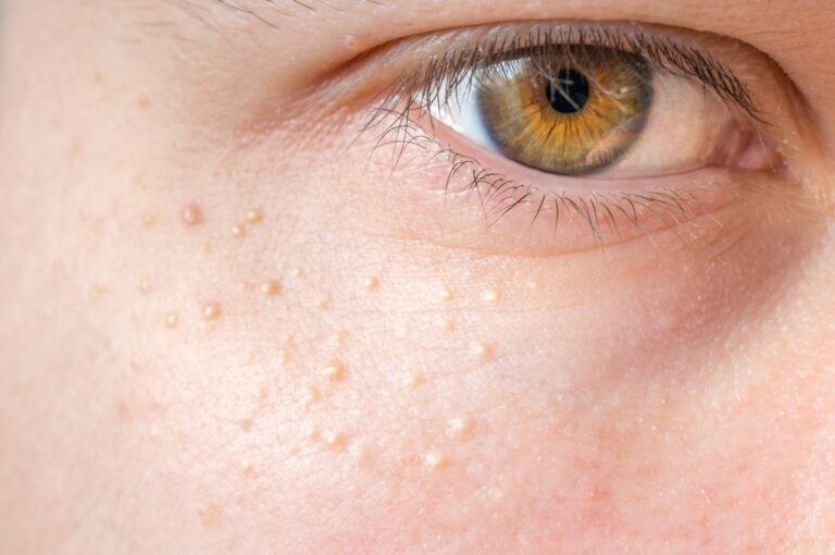 Milia (Milium) - pimples around eye on skin. Milia (Milium) - pimples around eye on skin.