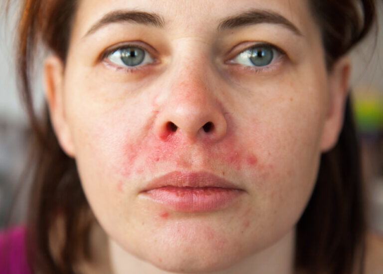 perioral dermatitis perioral dermatitis, woman's face with perioral dermatitis