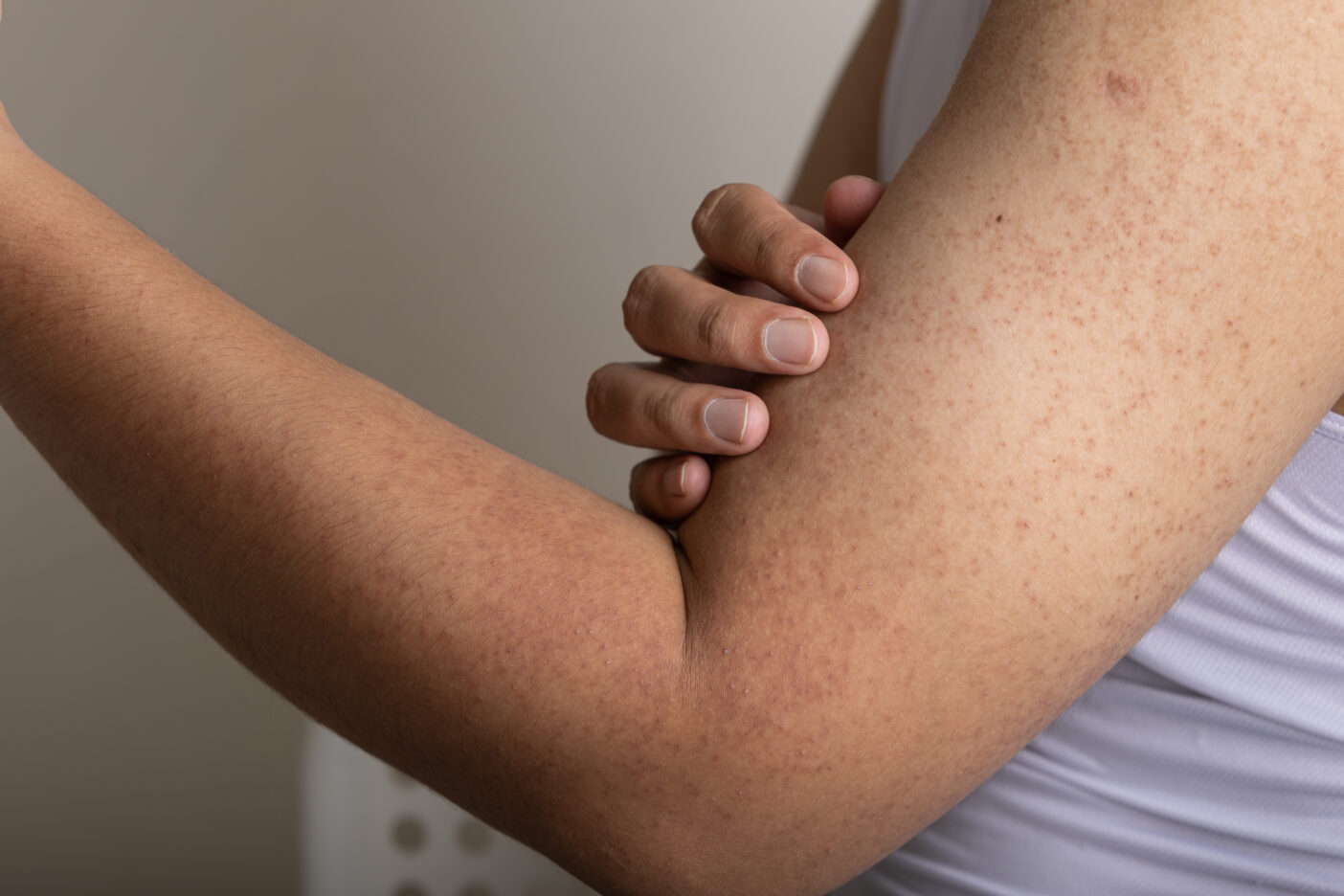 It affects hair follicles, which become hardened and palpable, which is why it is also known colloquially as chicken skin or scurvy goose bumps.