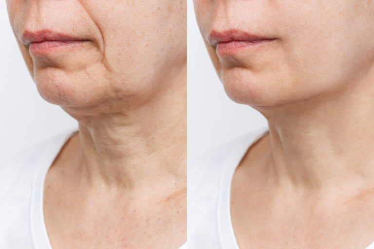 Gesichtsvolumenverlust durch Abnehmen, Ozempic face